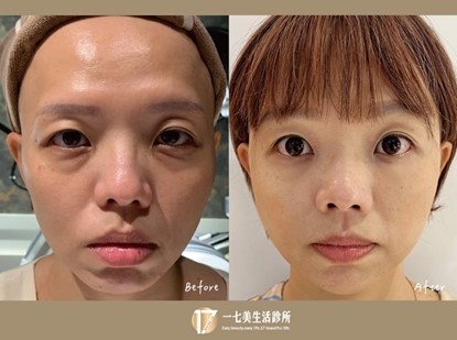 #Ellanse洢蓮絲 #Juvéderm喬雅登 #玻尿酸 除了能立即改善讓凹陷處豐填、飽滿之外，更提升到「既能豐填又能拉提」，尤其是從內(韌帶位置)深層地改善進而拉提韌帶並撐起鬆垮的肌膚。