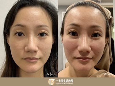 #玻尿酸韌帶拉提術不同以往「玻尿酸已經不等於填充而已~」#玻尿酸 除了能立即改善讓凹陷處豐填、飽滿之外，更提升到「既能豐填又能拉提」，尤其是從內(韌帶位置)深層地改善進而拉提韌帶並撐起鬆垮的肌膚。