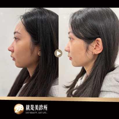 BA照-410x410-下巴精雕.jpg