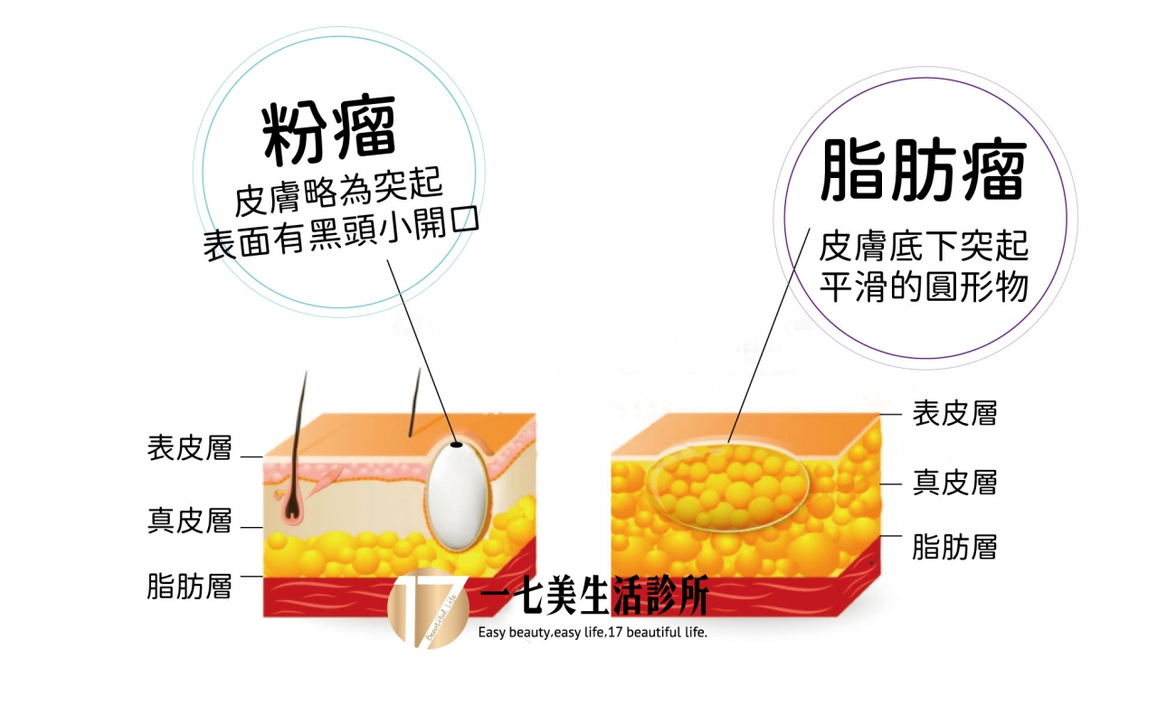 粉瘤vs脂肪瘤-比較-298就是美