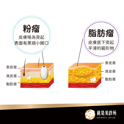 粉瘤1.jpg 粉瘤1.jpg