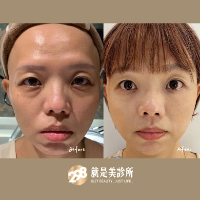 玻尿酸 全臉韌帶拉提・液態拉皮