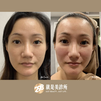 玻尿酸全臉精雕・隱形拉提