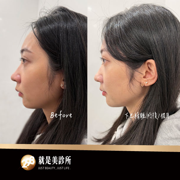BA照-610x610-下巴精雕.jpg