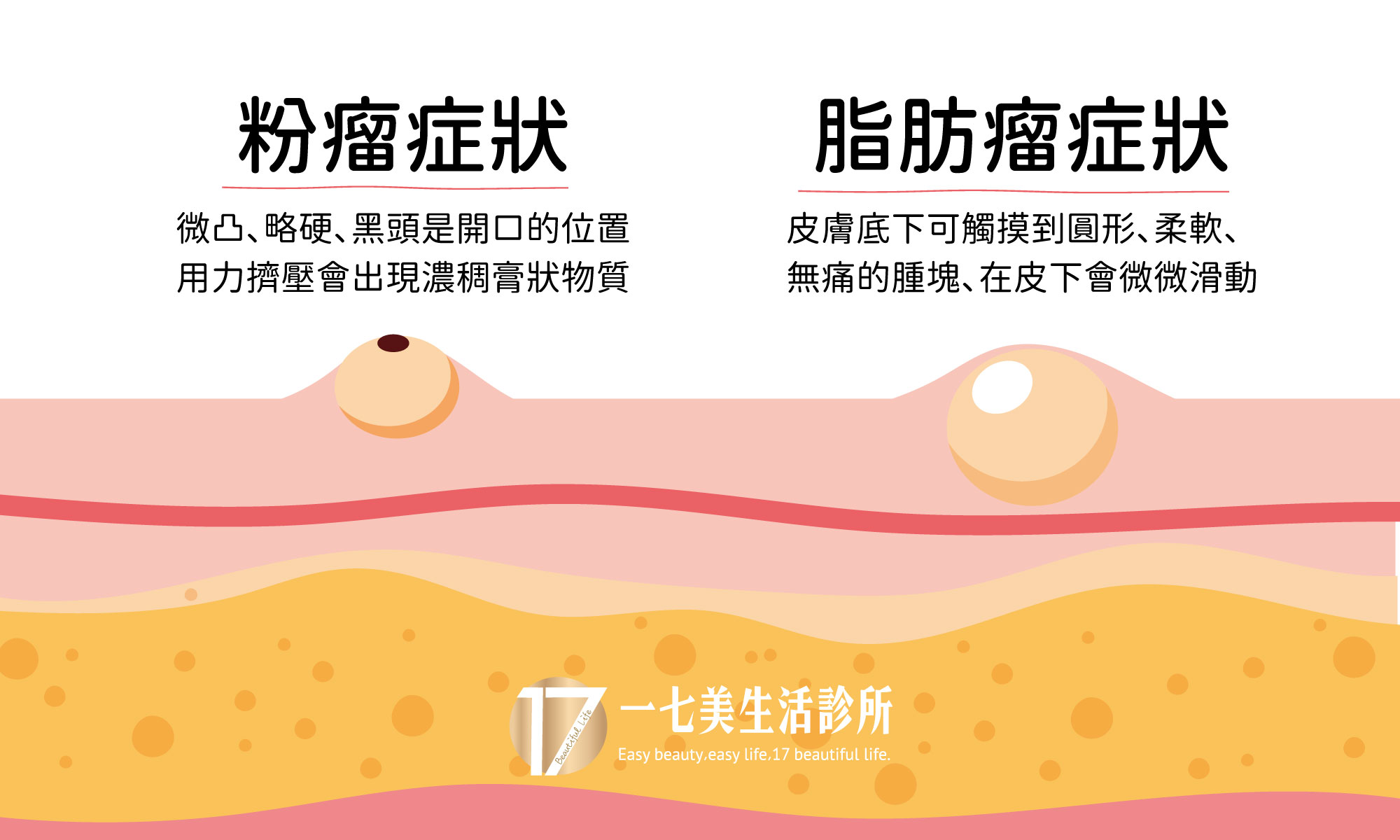 脂肪瘤手術示意