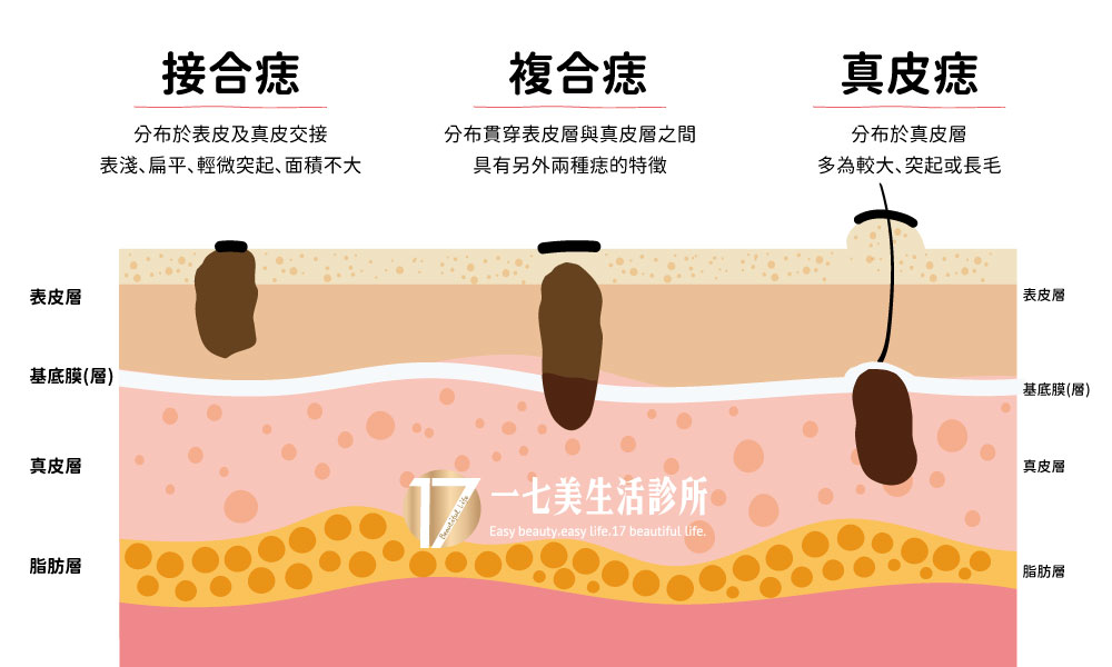 痣-三種痣-298就是美診所