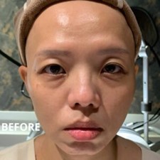 術前臉部狀態