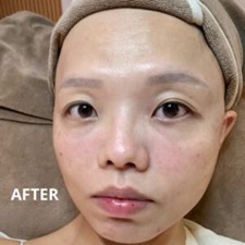 術後即時效果