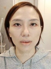 洢蓮絲療程前臉部狀態
