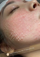 水光注射4