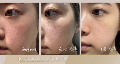 水光注射-298就是美