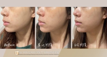 水光注射-298就是美