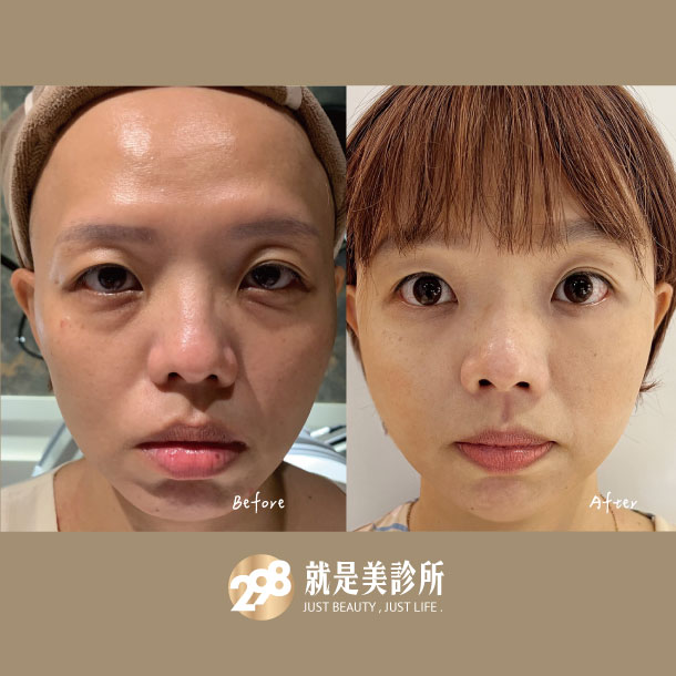 玻尿酸-298就是美