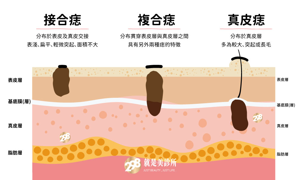 痣-三種痣-298就是美診所