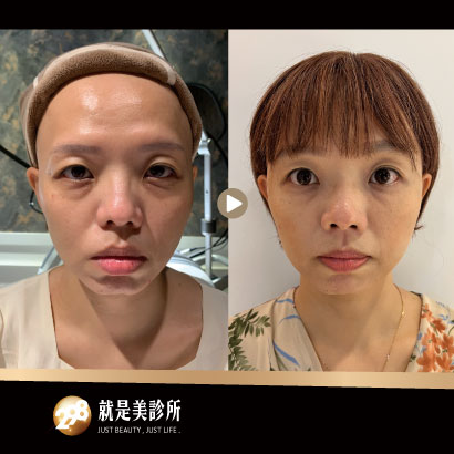 玻尿酸韌帶拉提術