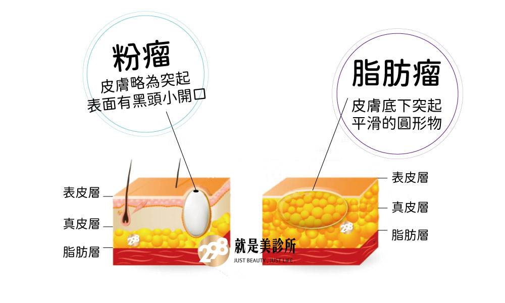 粉瘤示意