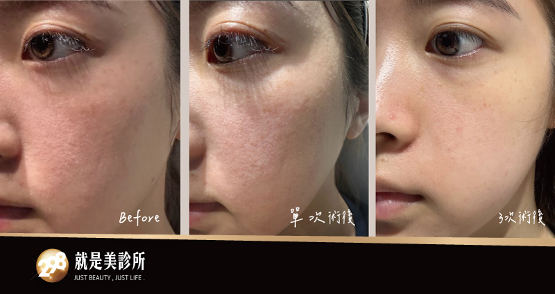 水光注射-298就是美